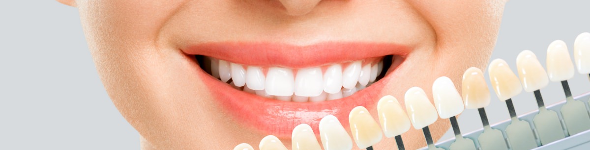 ホワイトニング